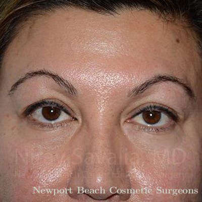 Brow Lift Before & After Gallery - Patient 1655728 - Before