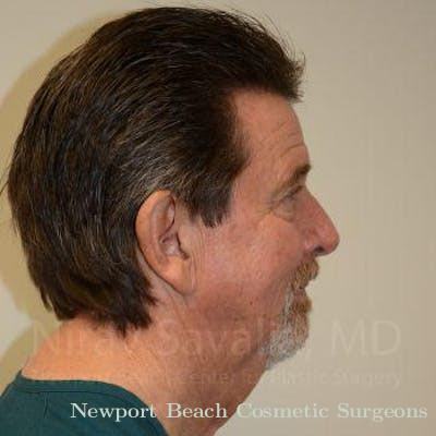 Facelift Before & After Gallery - Patient 1655726 - Before