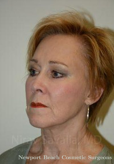 Facelift Before & After Gallery - Patient 1655725 - After