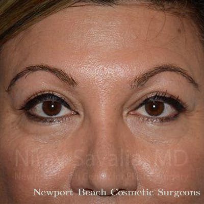 Brow Lift Before & After Gallery - Patient 1655728 - After