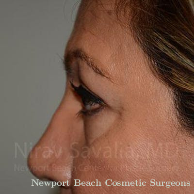 Facelift Before & After Gallery - Patient 1655728 - After