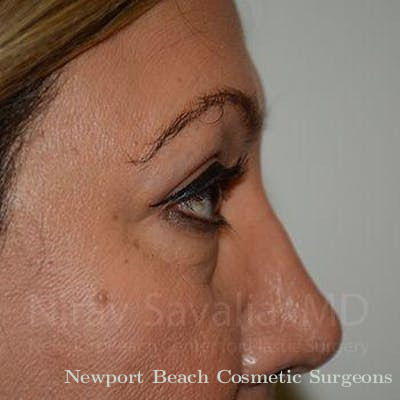 Facelift Before & After Gallery - Patient 1655728 - After