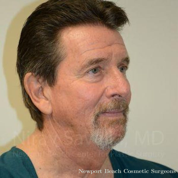 Oncoplastic Reconstruction Before & After Gallery - Patient 1655726 - Before