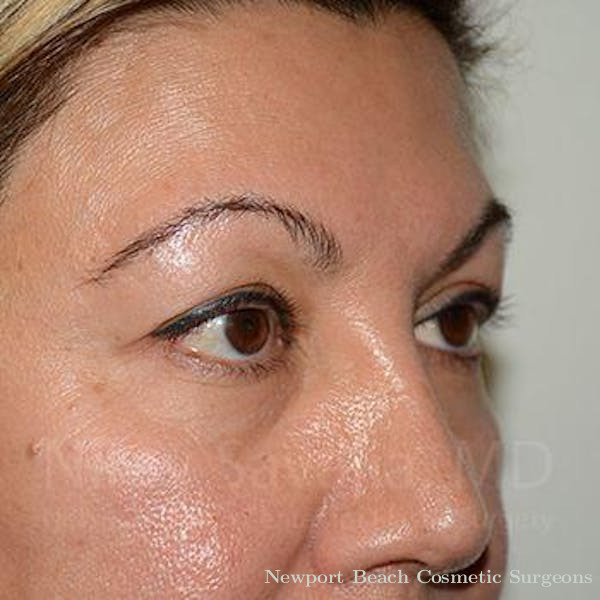 Fat Grafting to Face Before & After Gallery - Patient 1655728 - Before