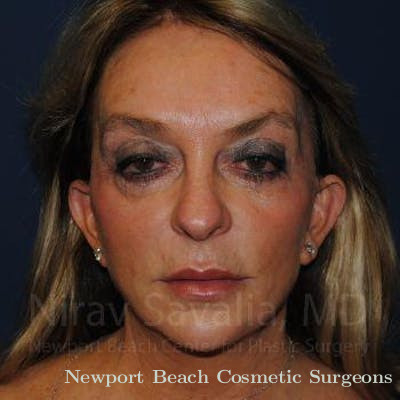 Mastectomy Reconstruction Before & After Gallery - Patient 1655730 - Before
