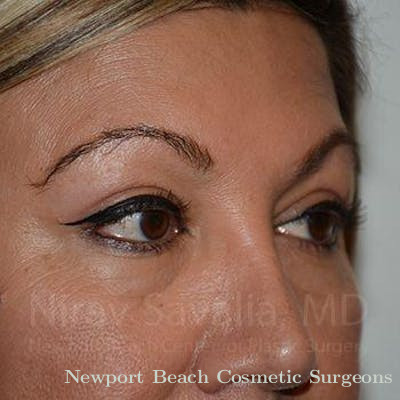Eyelid Surgery Before & After Gallery - Patient 1655728 - After