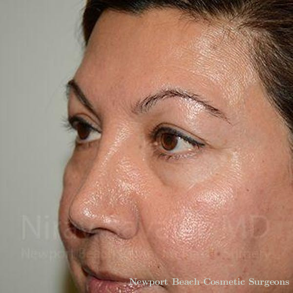 Oncoplastic Reconstruction Before & After Gallery - Patient 1655728 - Before