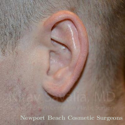 Torn Earlobe Repair Ear Gauge Repair Before & After Gallery - Patient 1655727 - After
