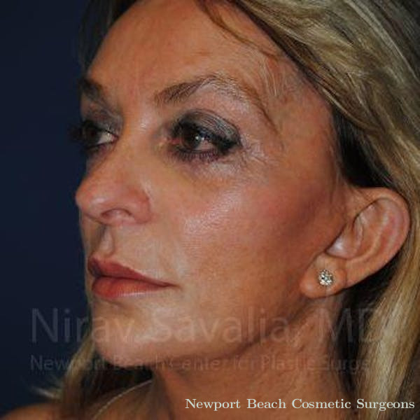 Facelift Before & After Gallery - Patient 1655730 - Before