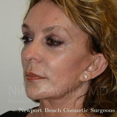 Facelift Before & After Gallery - Patient 1655730 - After