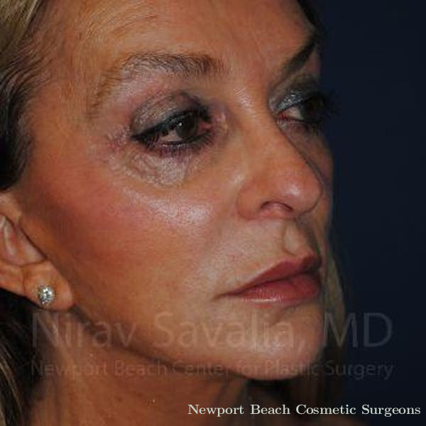 Mommy Makeover Before & After Gallery - Patient 1655730 - Before