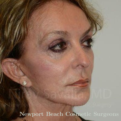Mommy Makeover Before & After Gallery - Patient 1655730 - After