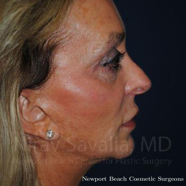 Chin Implants Before & After Gallery - Patient 1655730 - Before