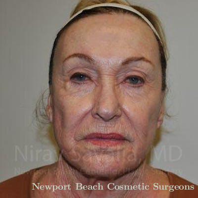 Facelift Before & After Gallery - Patient 1655786 - After