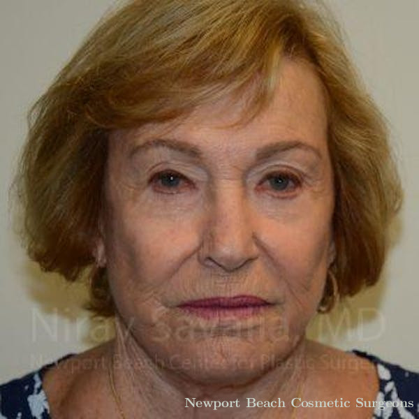 Facelift Before & After Gallery - Patient 1655786 - Before