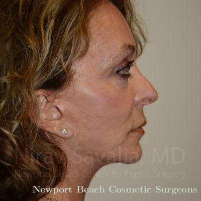 Oncoplastic Reconstruction Before & After Gallery - Patient 1655730 - After