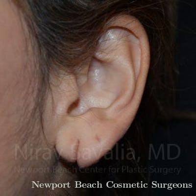 Torn Earlobe Repair Ear Gauge Repair Before & After Gallery - Patient 1655729 - Before