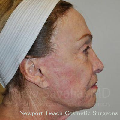 Fat Grafting to Face Before & After Gallery - Patient 1655786 - Before