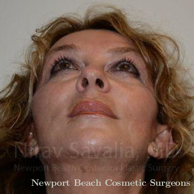 Facelift Before & After Gallery - Patient 1655730 - After
