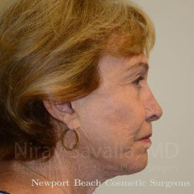 Eyelid Surgery Before & After Gallery - Patient 1655786 - After