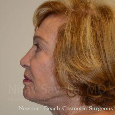Mastectomy Reconstruction Revision Before & After Gallery - Patient 1655786 - After