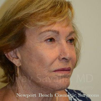 Facelift Before & After Gallery - Patient 1655786 - After