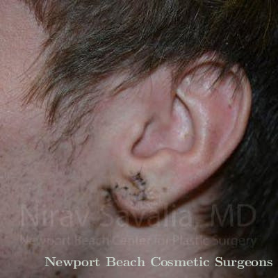Torn Earlobe Repair Ear Gauge Repair Before & After Gallery - Patient 1655788 - After
