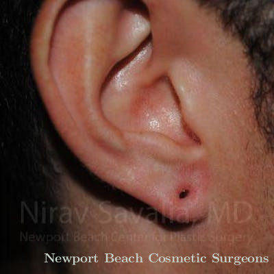 Torn Earlobe Repair Ear Gauge Repair Before & After Gallery - Patient 1655790 - Before