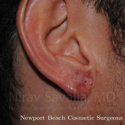 Torn Earlobe Repair Ear Gauge Repair Before & After Gallery - Patient 1655790 - After