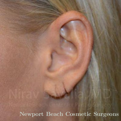 Torn Earlobe Repair Ear Gauge Repair Before & After Gallery - Patient 1655792 - Before