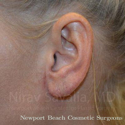Facelift Before & After Gallery - Patient 1655792 - After