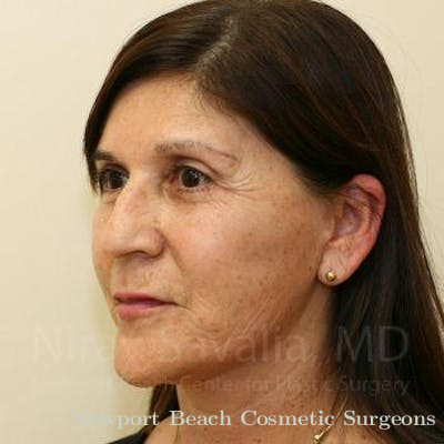 Oncoplastic Reconstruction Before & After Gallery - Patient 1655793 - After