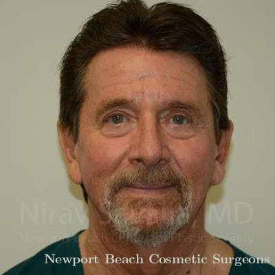 Facelift Before & After Gallery - Patient 1655796 - Before