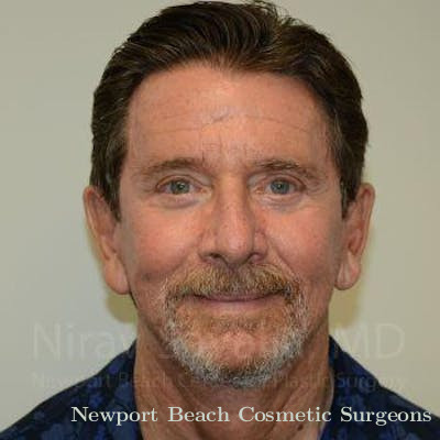 Chin Implants Before & After Gallery - Patient 1655796 - After