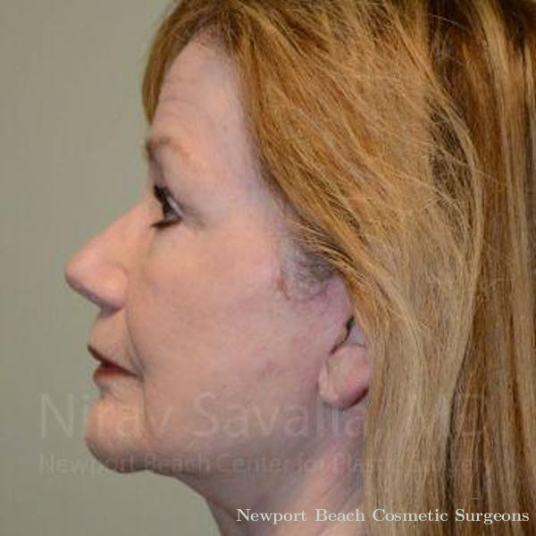 Liposuction Before & After Gallery - Patient 1655795 - Before