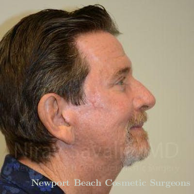 Torn Earlobe Repair Ear Gauge Repair Before & After Gallery - Patient 1655796 - After
