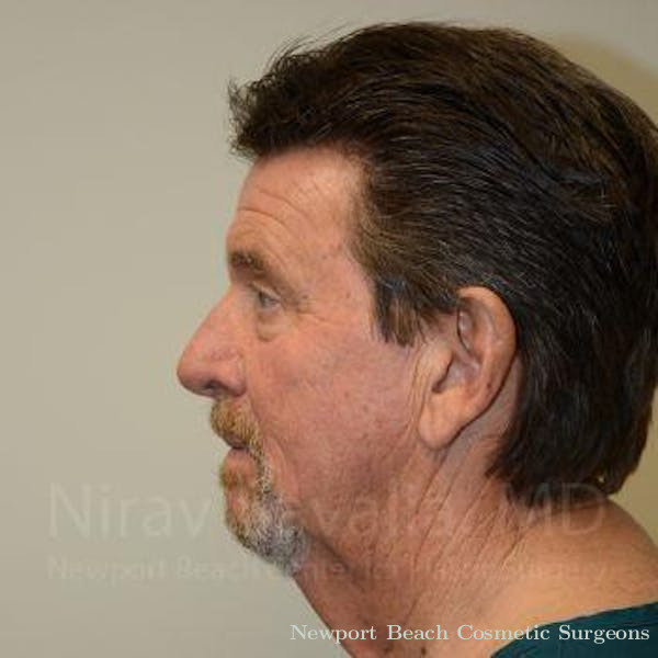 Facelift Before & After Gallery - Patient 1655796 - Before