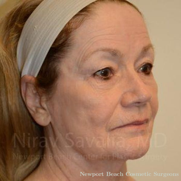 Facelift Before & After Gallery - Patient 1655795 - Before
