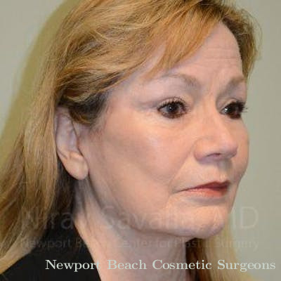 Brow Lift Before & After Gallery - Patient 1655795 - After