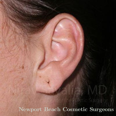 Breast Explantation En Bloc Capsulectomy Before & After Gallery - Patient 1655797 - Before