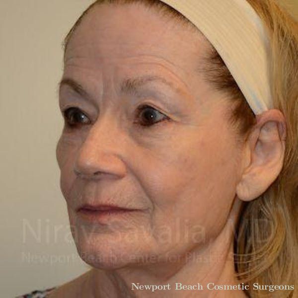 Fat Grafting to Face Before & After Gallery - Patient 1655795 - Before