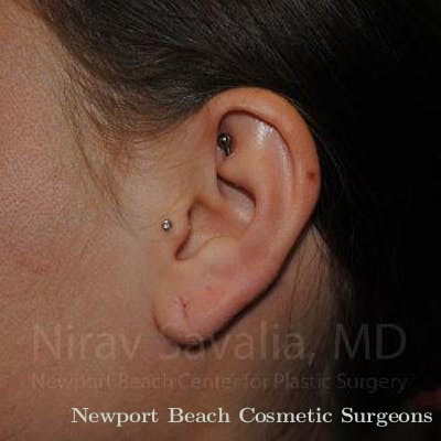 Torn Earlobe Repair Ear Gauge Repair Before & After Gallery - Patient 1655798 - Before