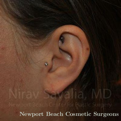 Torn Earlobe Repair Ear Gauge Repair Before & After Gallery - Patient 1655798 - After