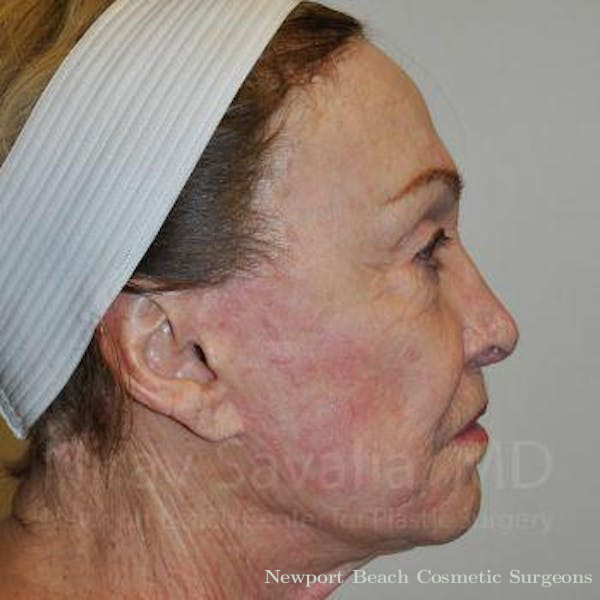 Oncoplastic Reconstruction Before & After Gallery - Patient 1655799 - Before