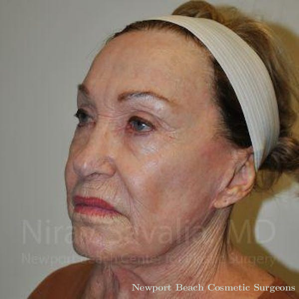Chin Implants Before & After Gallery - Patient 1655799 - Before