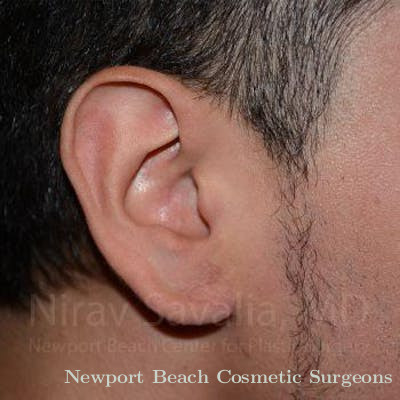 Chin Implants Before & After Gallery - Patient 1655801 - After