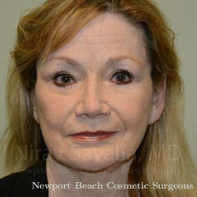 Liposuction Before & After Gallery - Patient 1655803 - After