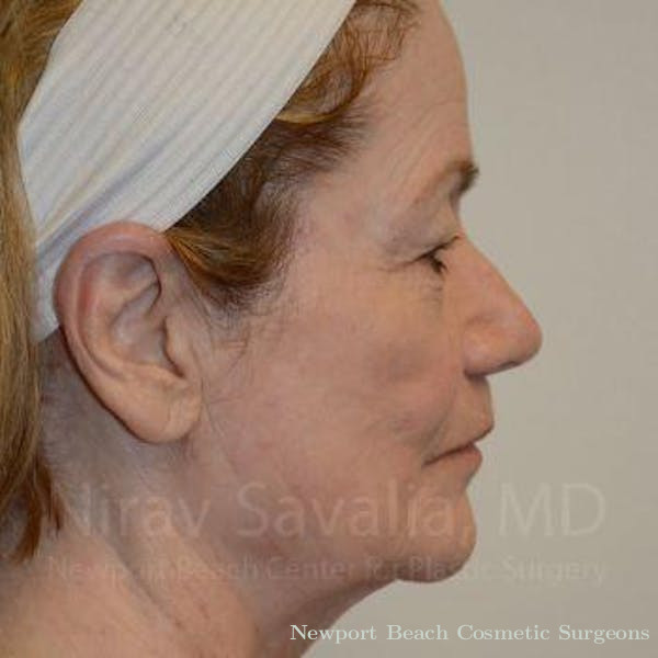 Fat Grafting to Face Before & After Gallery - Patient 1655803 - Before