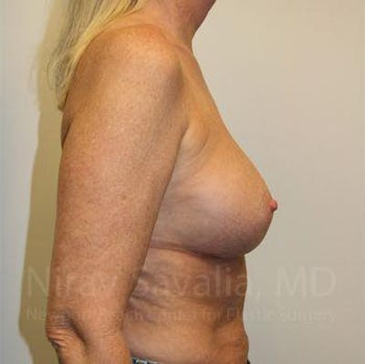 Mastectomy Reconstruction Before & After Gallery - Patient 1655444 - After