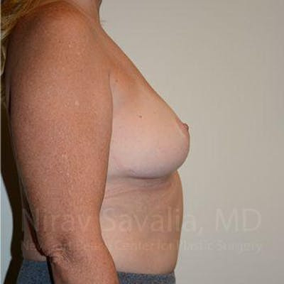 Breast Explantation En Bloc Capsulectomy Before & After Gallery - Patient 1655446 - After